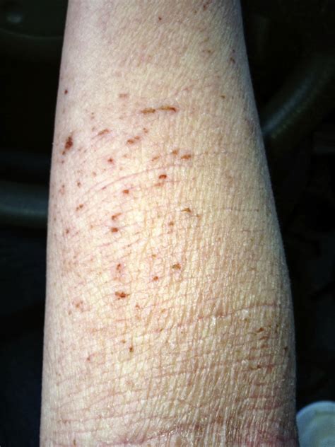 Scratching The Surface Of Topical Steroid Withdrawal Day 169