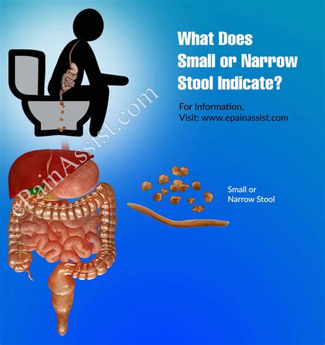 Great Narrowing Of Stool Of All Time Learn More Here Stoolz