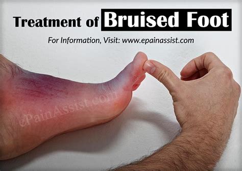Bruised Footcausessymptomstreatmenthealing Time