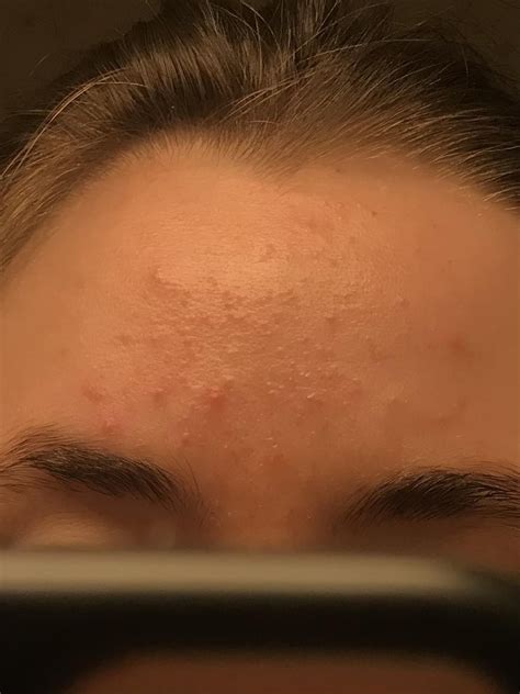 Skin Concerns My Main Concerns Are These Bumps On My Forehead And