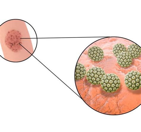 Human Papillomavirus Hpv Hpv Causes Skin And Genital Warts Sexiz Pix
