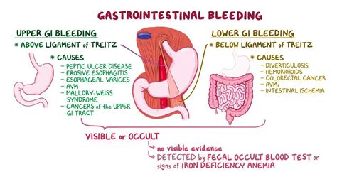 Gastrointestinal Bleeding Clinical Practice Osmosis