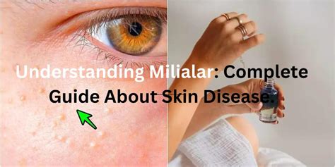 Understanding Milialar Complete Guide About Skin Disease