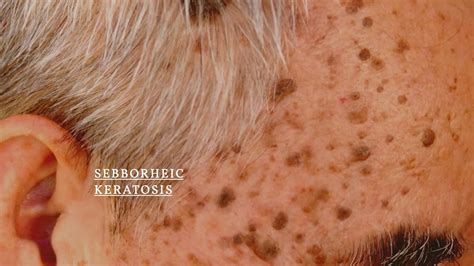 What Is Seborrheic Keratosis Age Spots And Sun Spot Remover