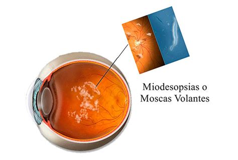 Miodesopsias ¿qué Es Síntomas Causas Y Tratamiento Blog Mdc