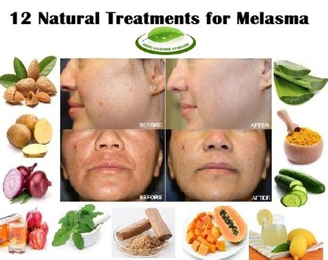 Check spelling or type a new query. Pin on Melasma Treatment