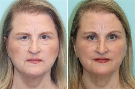 Blepharoplasty Brow Lift Photos Chevy Chase Md Patient 25772