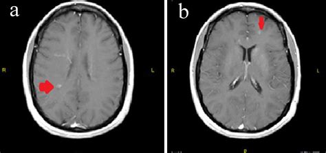 Mri Brain Without Contrast Change Comin