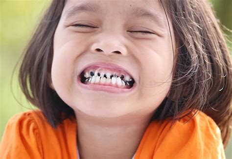 How To Deal With Chipped Tooth In Child