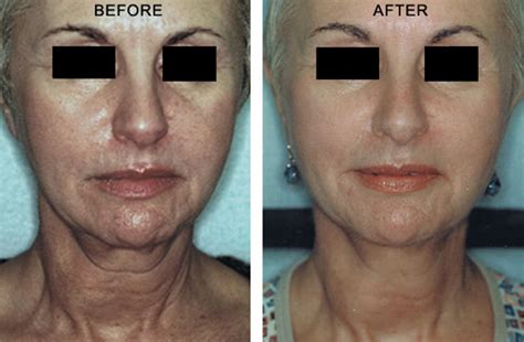 Non Surgical Neck Lift Ny Before And After Pictures