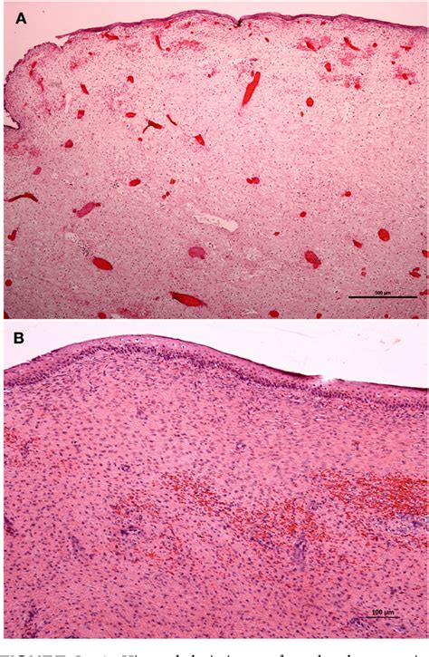 Figure From Recurrent Urethral Fibroepithelial Polyps In A Golden