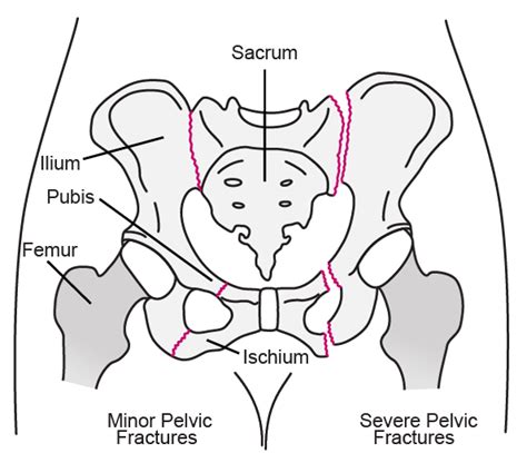 Table Pelvic Fractures Msd Manual Consumer Version