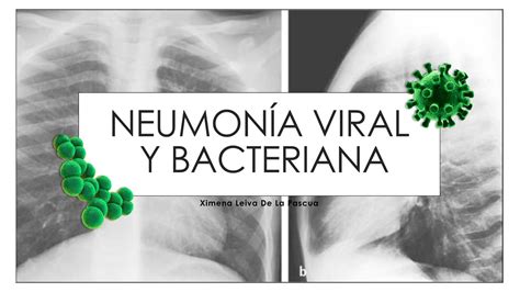 Clase 9 Neumonía Viral Y Bacteriana Youtube