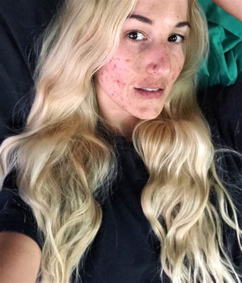 Woman 30 Who Developed Painful Cystic Acne Vows To Ditch Filters And