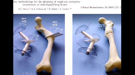 Management Of Lower Extremity Diaphyseal Malunion Youtube