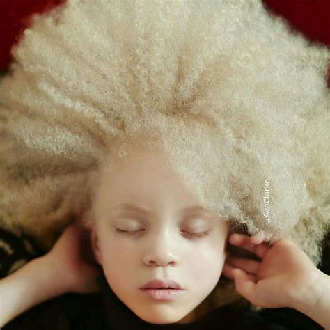 10 Photos Qui Dévoilent La Beauté Des Personnes Albinos