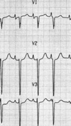 Right Atrial Enlargement LITFL Medical Blog ECG Library Basics