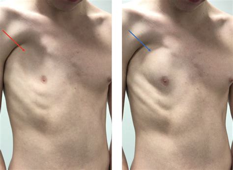 chest wall abnormalities