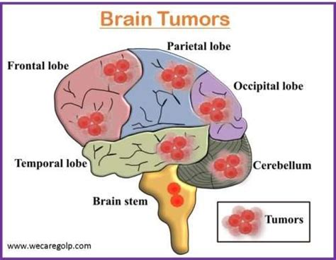 Brain Tumor Benign And Malignant We Care
