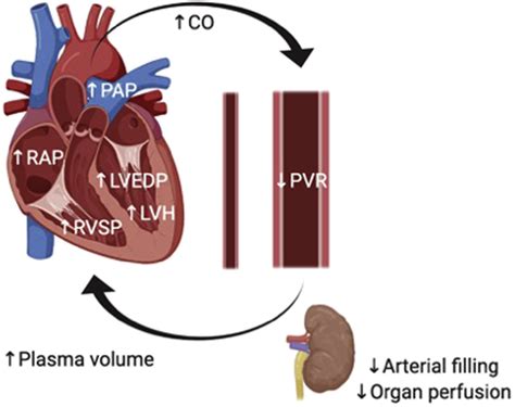 High Output Heart Failure Associated With Arteriovenous Fistula In The