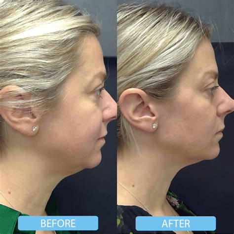 Double Chin Treatment In Toronto Vita Cosmetic And Laser Clinic