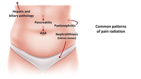 An Approach To Acute Abdominal Pain YouTube
