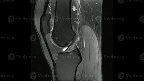 Magnetic Resonance Images Of The Knee Joint Sagittal Proton Density Image Mri Knee Joint