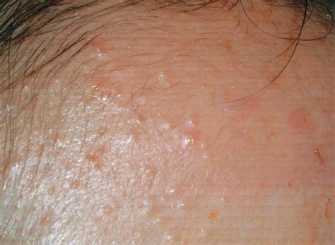 What Is Fungal Acne Everything You Need To Know Including Appropriate