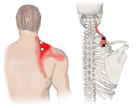 The Levator Scapulae Muscle Scapula Muscles Of The Neck Trigger Points