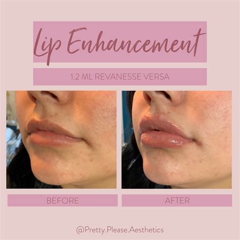 Lip Filler Before And After Lip Fillers Facial Aesthetics Natural Lips