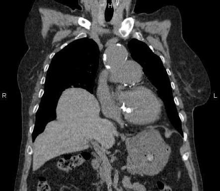 Diaphragmatic Eventration Radiology Reference Article Radiopaedia Org