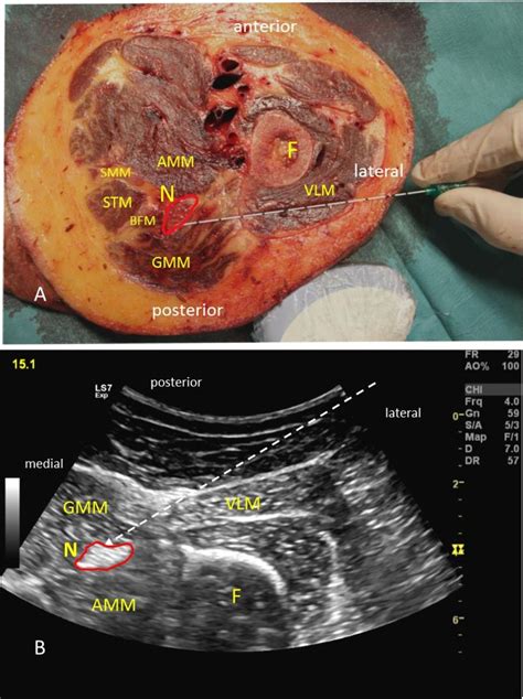 Essential equipment includes an ultrasound. Proximal lateral approach to ultrasound-guided sciatic ...