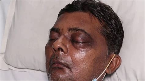 Hugo arias, enfermero hospital doctor augusto esmann. Reportan casos de hongo negro tras contagios de COVD-19 ...