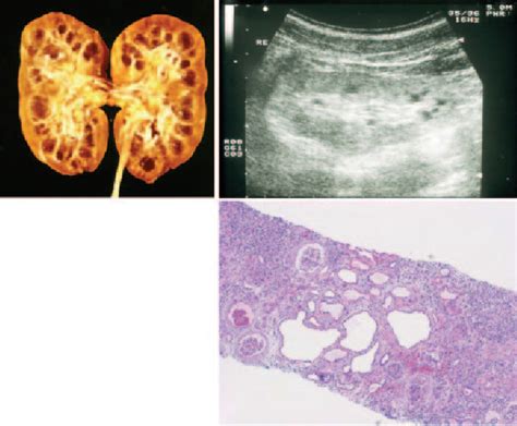 Figure 1 From Nephronophthisis A Frequent Genetic Cause Of Kidney