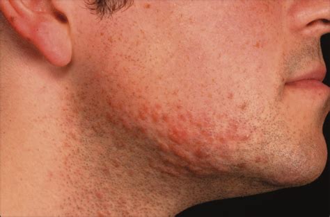 Painful Red Spots On The Cheek Of A Young Man—quiz Case Dermatology