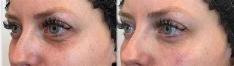 Dermal Fillers Before And After Photo Gallery Elk Grove Folsom