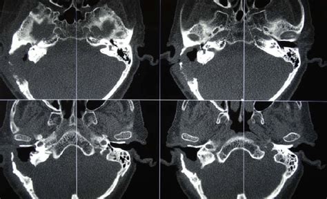 Hrct Of Temporal Bone Showing Peripherally Enhancing Collection In