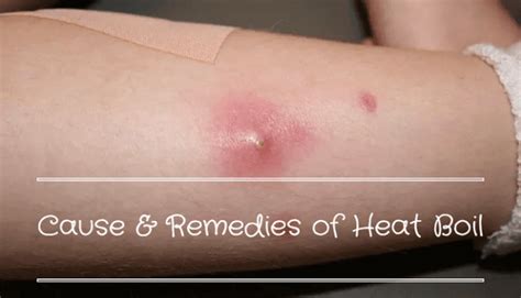 Heat Boil Causes Symptoms And Easy Home Remedies Home Remedy For