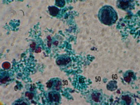 White Blood Cells In Stool