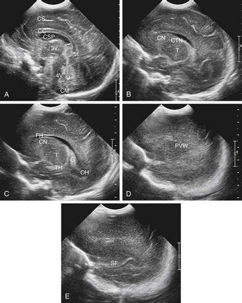Premature Birth Rule Out Germinal Matrix Hemorrhage Radiology Key