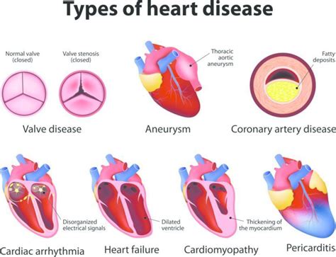 Heart Disease Symptoms Causes Treatment And Diagnosis Findatopdoc