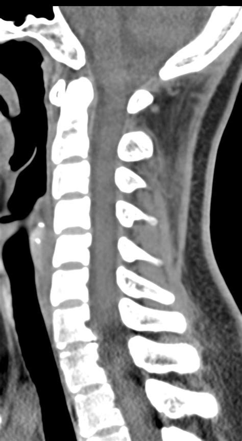 Normal Cervical Spine CT Image Radiopaedia Org
