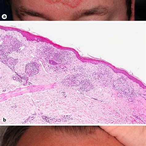 A Hypopigmented And Atrophic Lesion With Indurated Erythematous Border