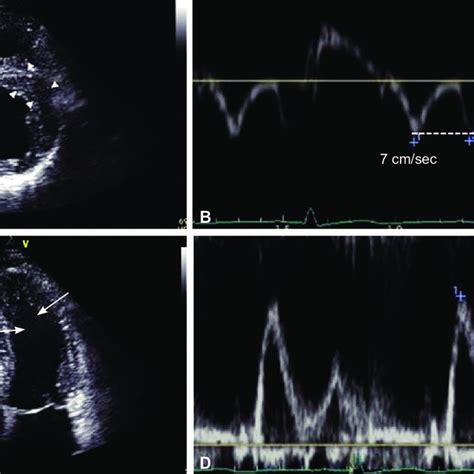 Echocardiographic Findings In Patient 4 A Only Localized Area Of