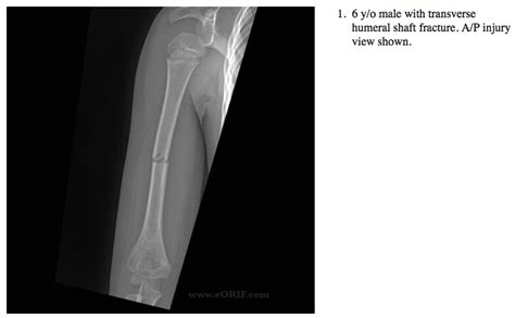 Pediatric Humeral Shaft Fracture S42399a 81221 Eorif