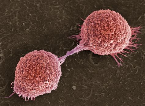 Oral Squamous Cell Carcinoma Cells Completing Cell Division This