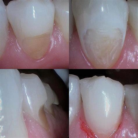 Abfraction Is A Non Carious Not A Cavity Tooth Loss That Occurs