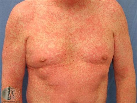 Common Skin Rashes And What To Do About Them — Richard Lebert