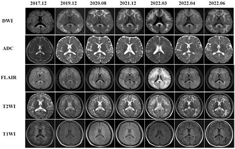 Frontiers Longitudinal Course Of Hyperintensity On Diffusion Weighted