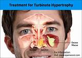 Pictures of Enlarged Turbinates Treatment